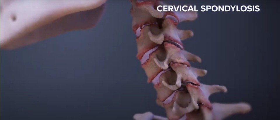 Cervical Spondylosis