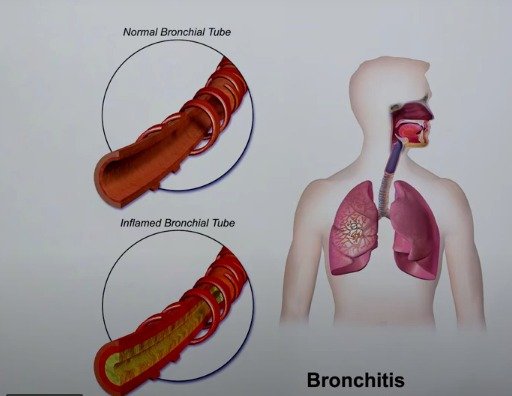 bronchitis