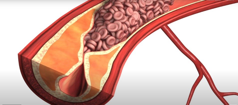 Arteriosclerosis