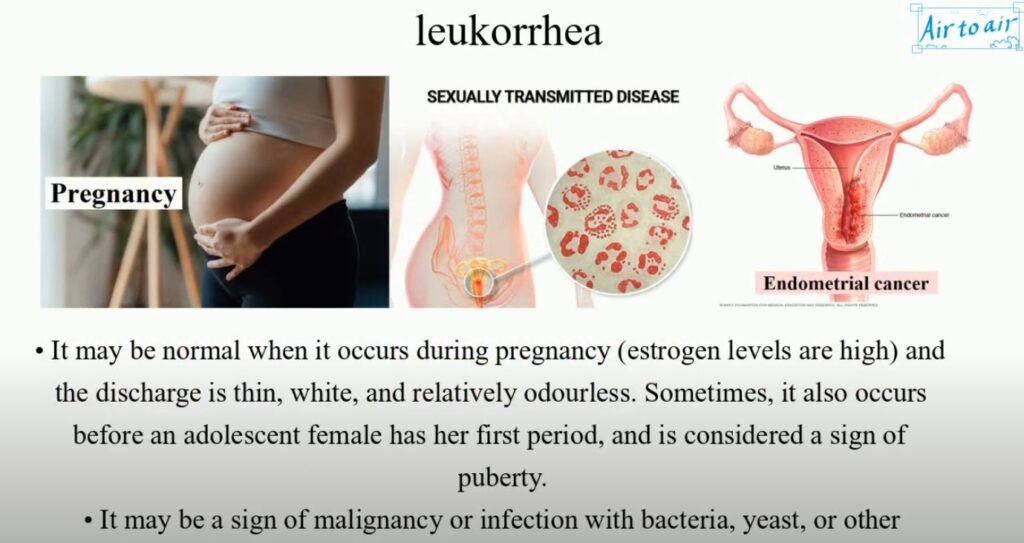 Leucorrhoea