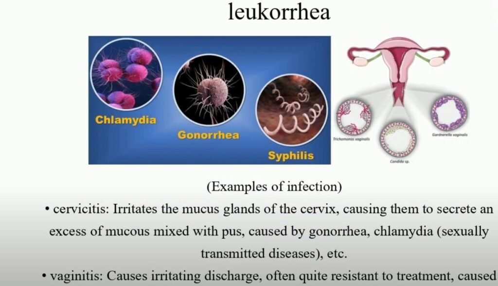 Leucorrhoea