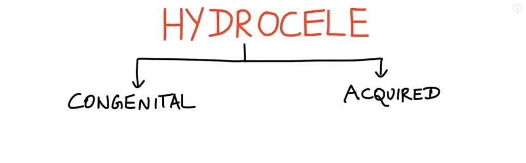 hydrocele